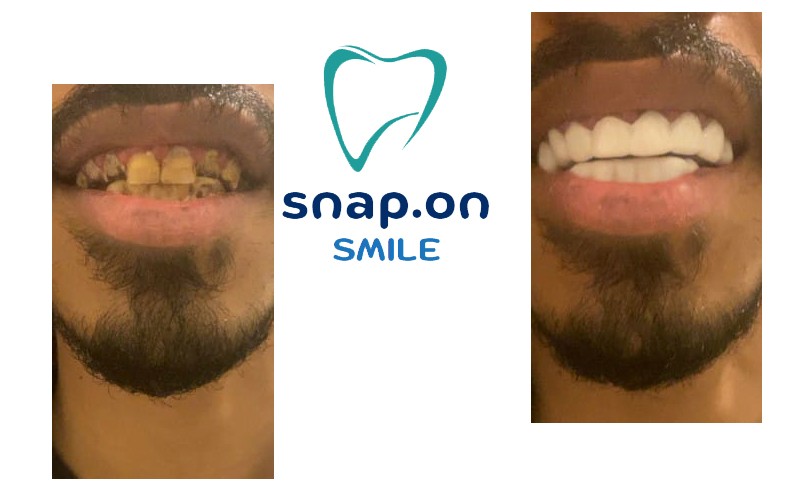 ٍSnap on Smile